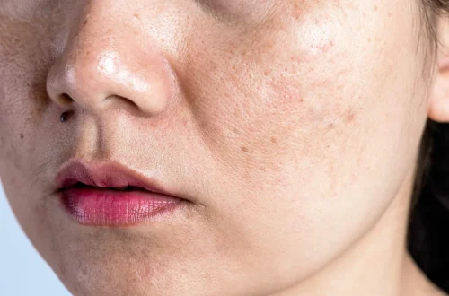 Why Are My Pores So Big Causes and Solutions