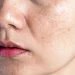 Why Are My Pores So Big Causes and Solutions