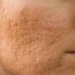 Are Big Pores Bad
