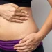 Do Stretch Marks Go Away Causes and Treatments