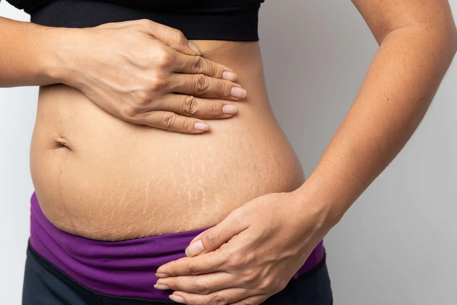 Do Stretch Marks Go Away Causes and Treatments