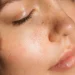 Why Are My Pores So Visible Causes and Fixes